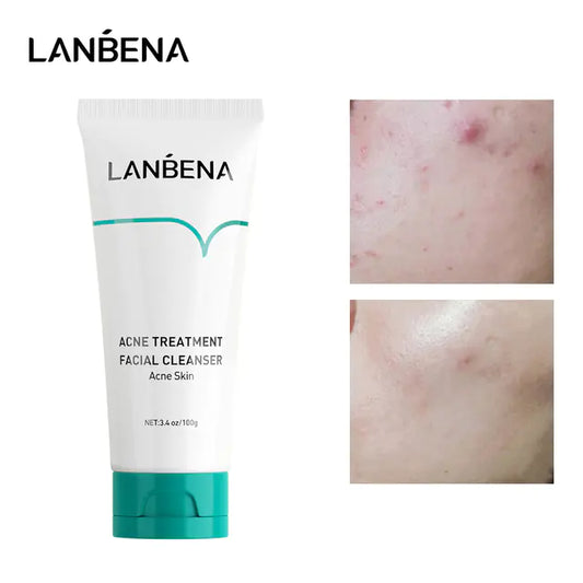 LANBENA VC Whitening Facial Foam for Acne Treatment